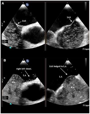 Calf muscle pump tensing as a novel maneuver to improve the diagnostic performance of detecting patent foramen ovale during transesophageal echocardiography